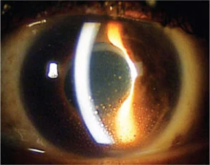 Anterior uveitis due to HZO. Deposits of white blood cells can be seen on the inner aspect of the cornea inferiorly.