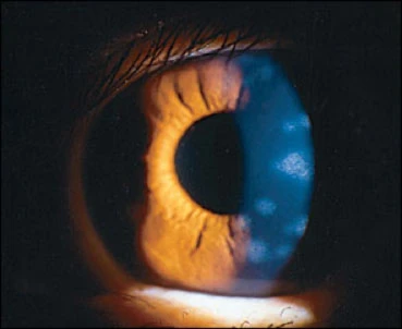 Herpes Zoster Ophthalmicus (HZO)