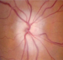Pale swollen optic disc, due to optic nerve infarction