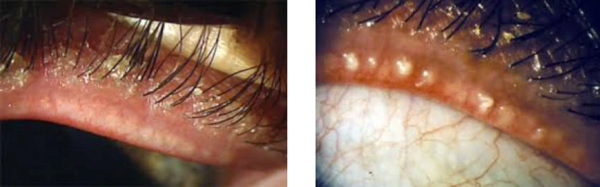 Left: anterior blepharitis. Right: posterior blepharitis