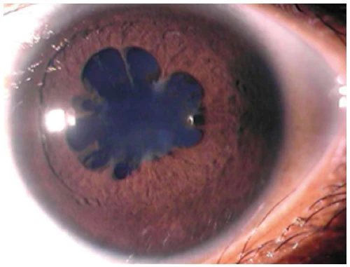 Posterior synechiae (iris adhesions to lens)