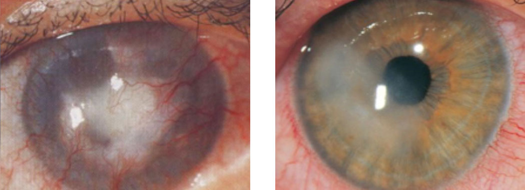 Stromal keratitis vs endothelial keratitis