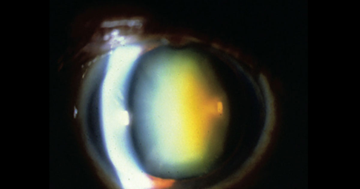 Bringing Clarity to Cataracts