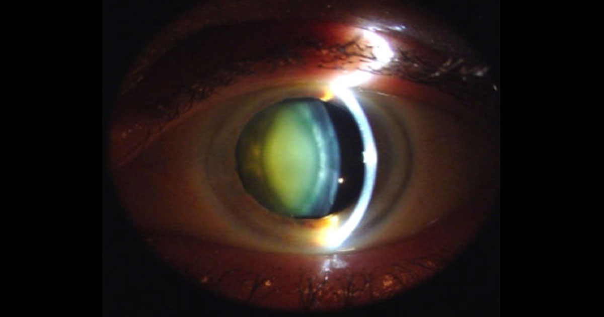 When is the right time to have cataract surgery?