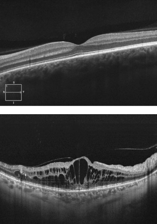 Ocular Coherence Tomogram (OCT)