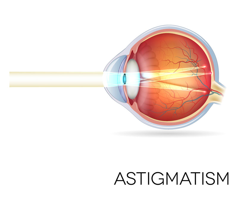 Diagram of the eye showing astigmatism