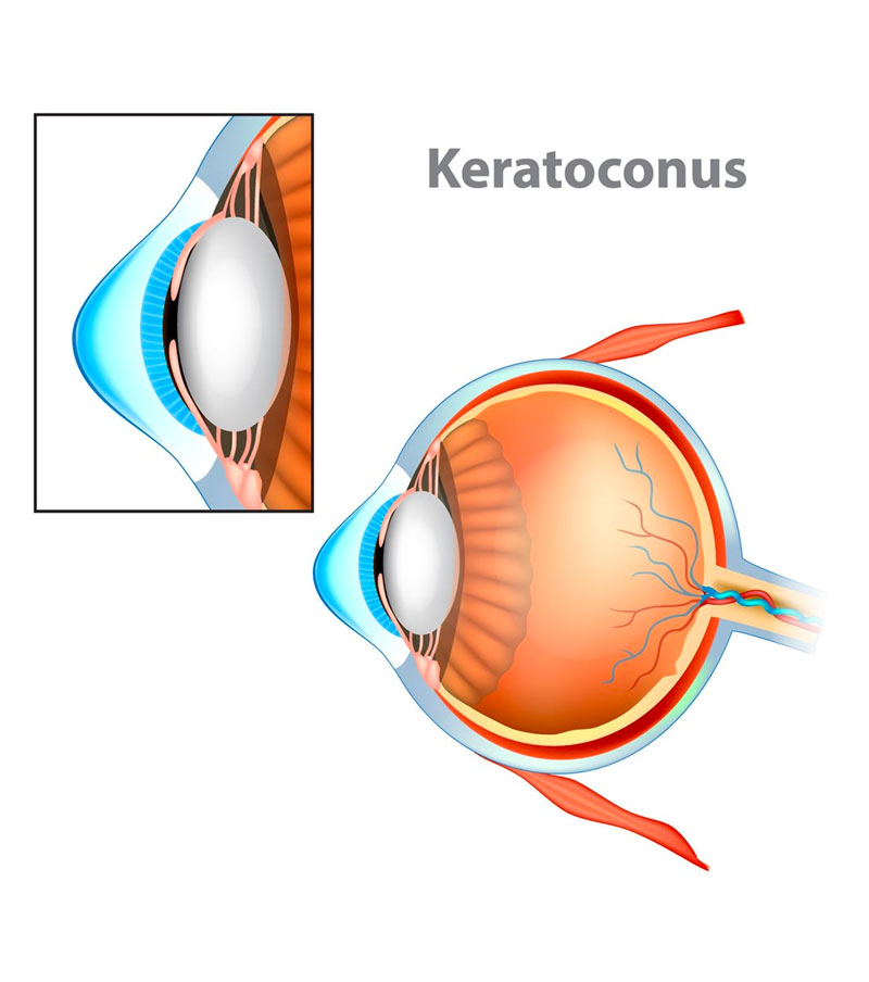 Pterygium