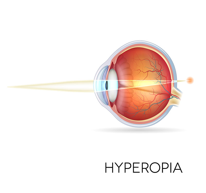 Diagram of the eye showing hyperopia