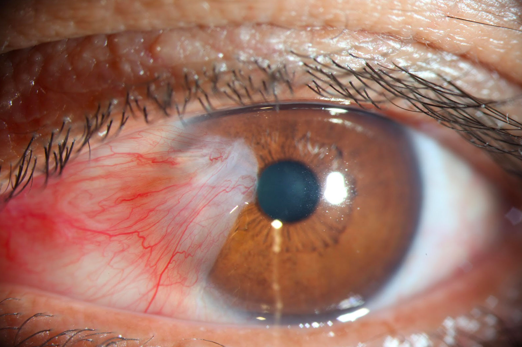 Pterygium