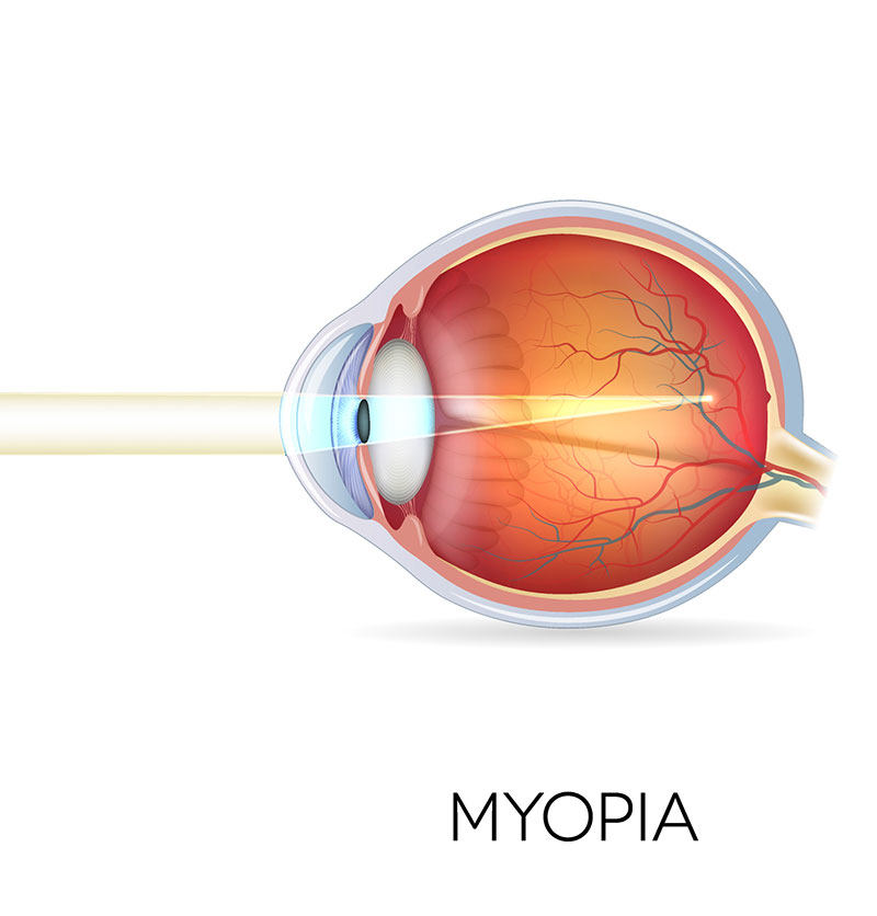 Diagram of the eye showing myopia