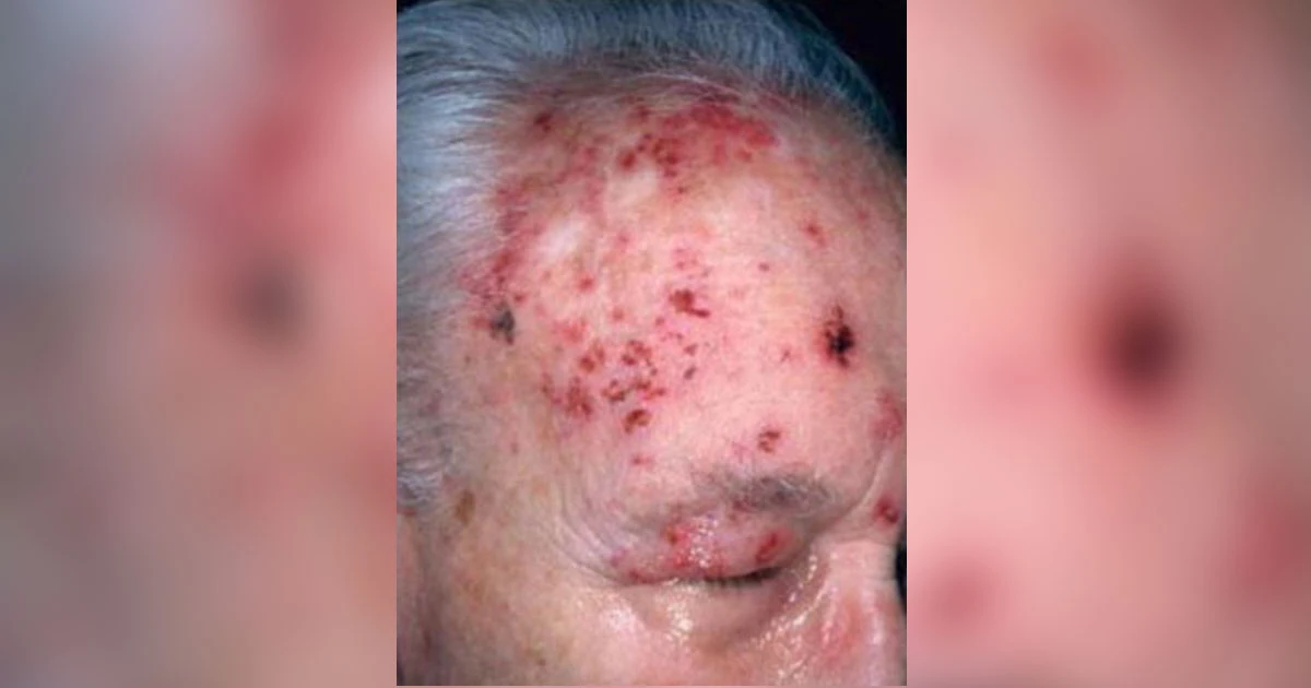 Herpes Zoster Ophthalmicus (HZO) is defined by involvement of the ophthalmic branch of the trigeminal nerve (CN V1). This branch supplies the forehead, the anterior scalp, the side and tip of the nose, ethmoidal sinuses, and importantly, all structures within the globe, including the retina and optic nerve. 