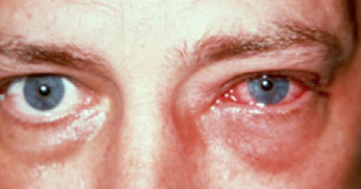 Viral conjunctivitis is a self-limiting condition, and the commonest cause of a red eye presentation in general practice. It is typically caused by adenovirus. Other, less common viruses include herpes simplex, herpes zoster, enterovirus, and coxsackie virus. 