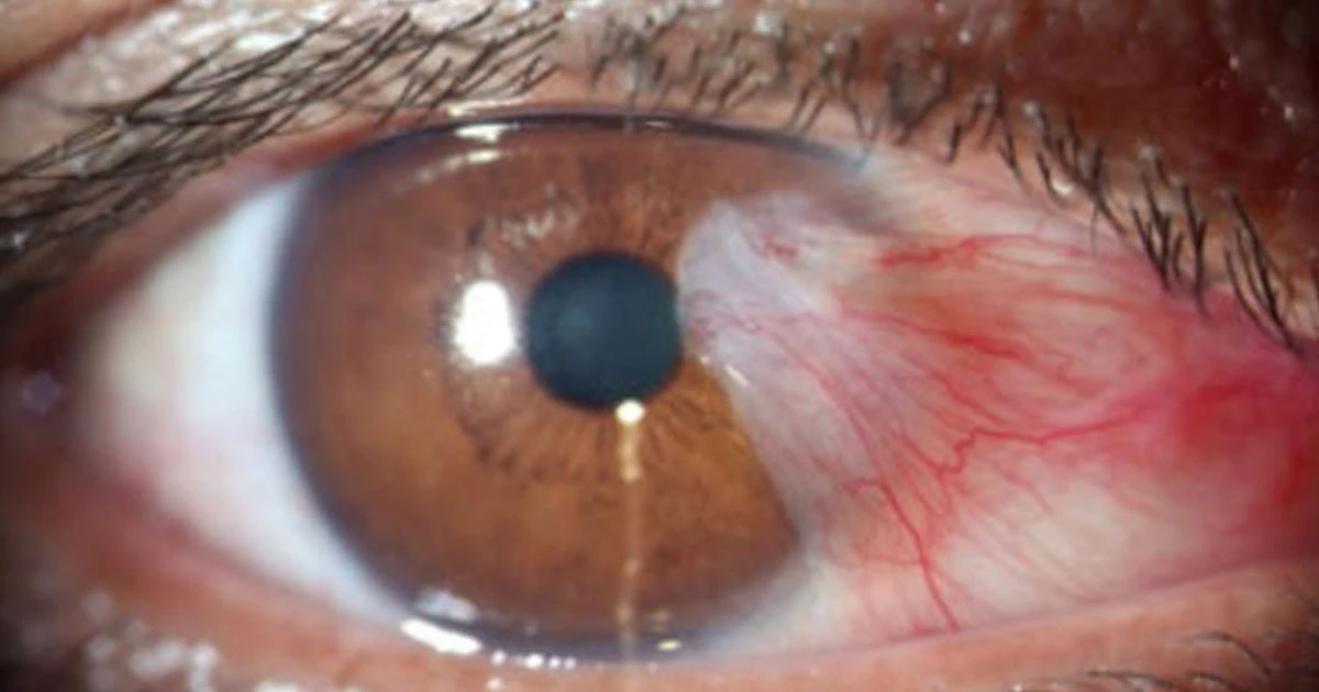 Pterygium (surfer’s eye) is a very common condition amongst Australians.  Advanced pterygia can cause distortion of the corneal shape, resulting in astigmatism. 