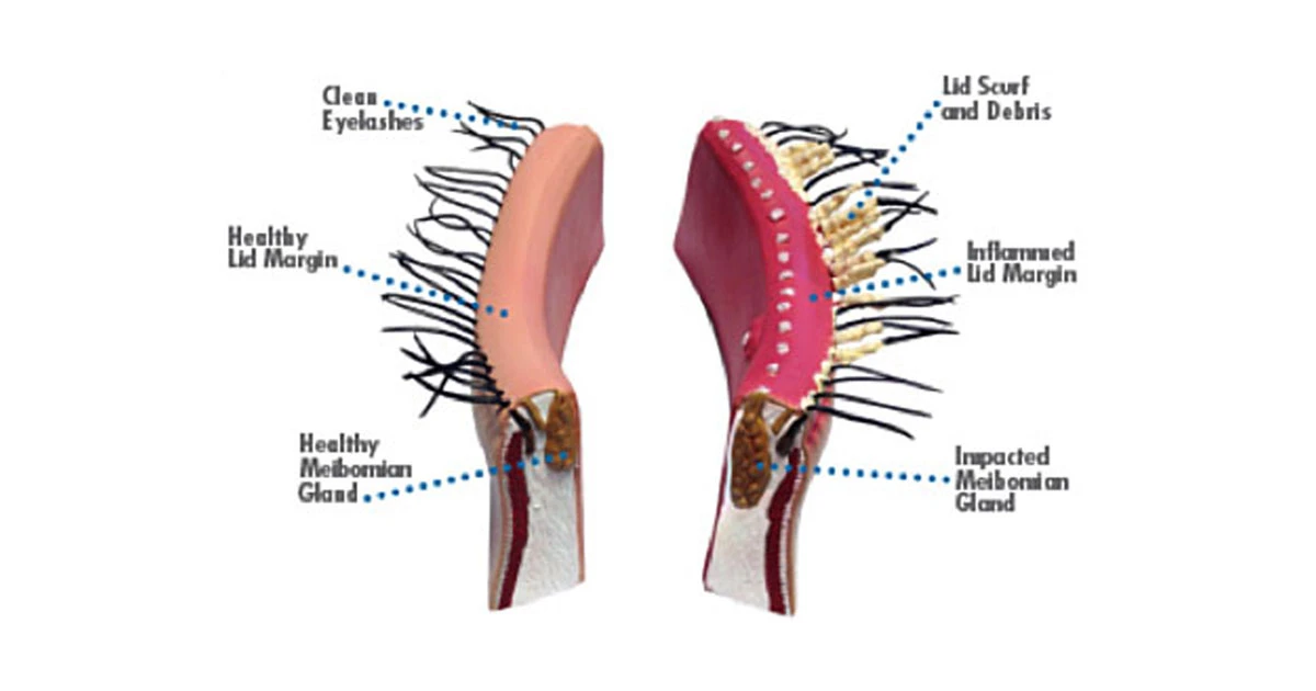 Blepharitis is common in both men and women, and affects all age groups including children. It is particularly common amongst post-menopausal women, which might point to the role of oestrogen in tear formation.