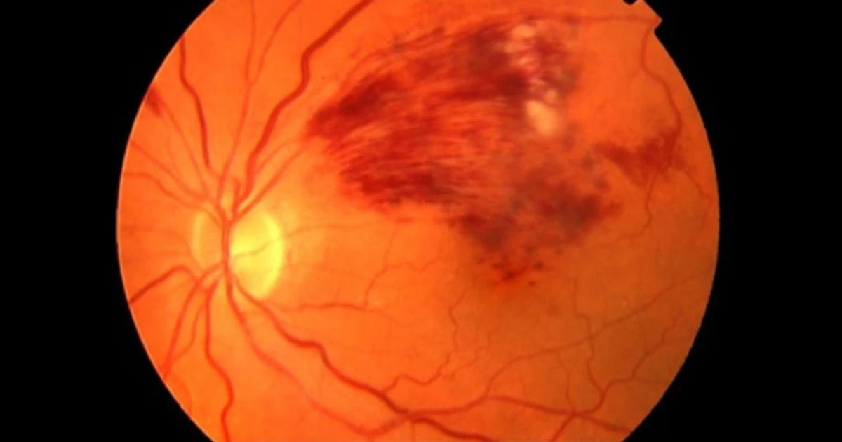 Branch retinal vein occlusion (BRVO) is a vascular occlusive disease of the retina, caused by thrombotic occlusion of a retinal venule where it is crossed by an arteriole.