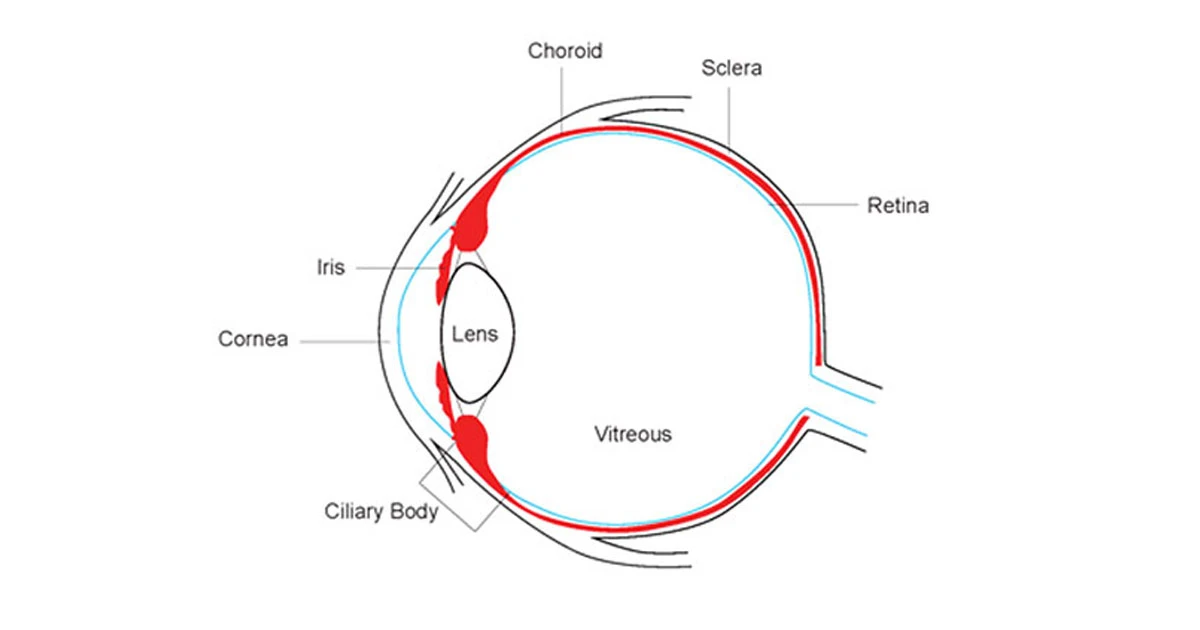 Anterior uveitis (iritis) accounts for the vast majority of uveitis seen in primary care. It usually, but not always, affects only one eye.