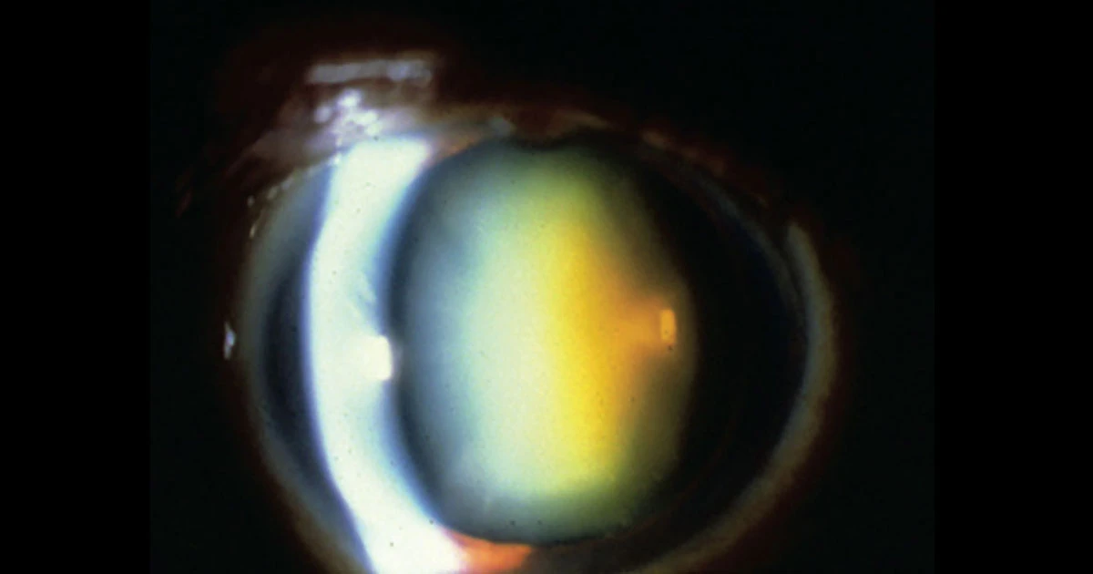 There is finally some welcome and overdue financial relief for patients with keratoconus and other types of corneal ectasia. 