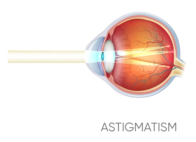 Astigmatism surgery Northern Beaches