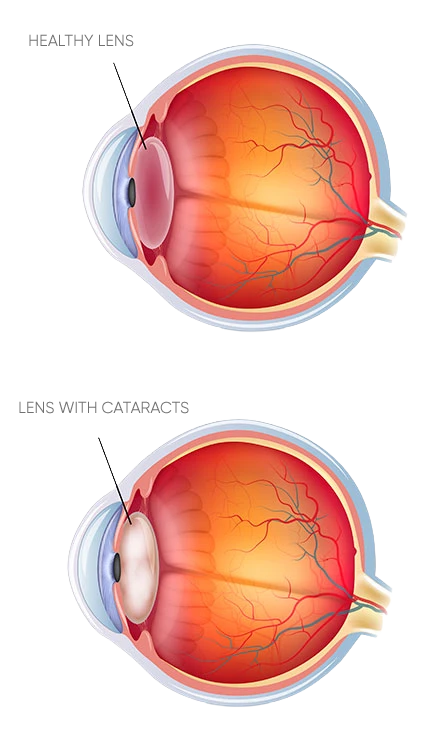 Medical illustration comparing healthy lens vs lens with cataracts