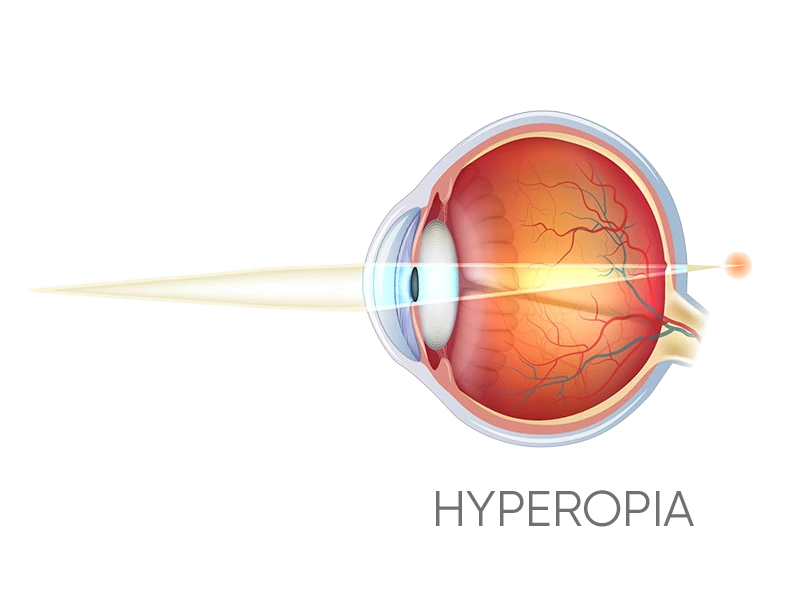 Long-sighted surgery Northern Beaches