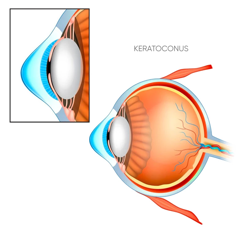 Keratoconus surgery Northern Beaches
